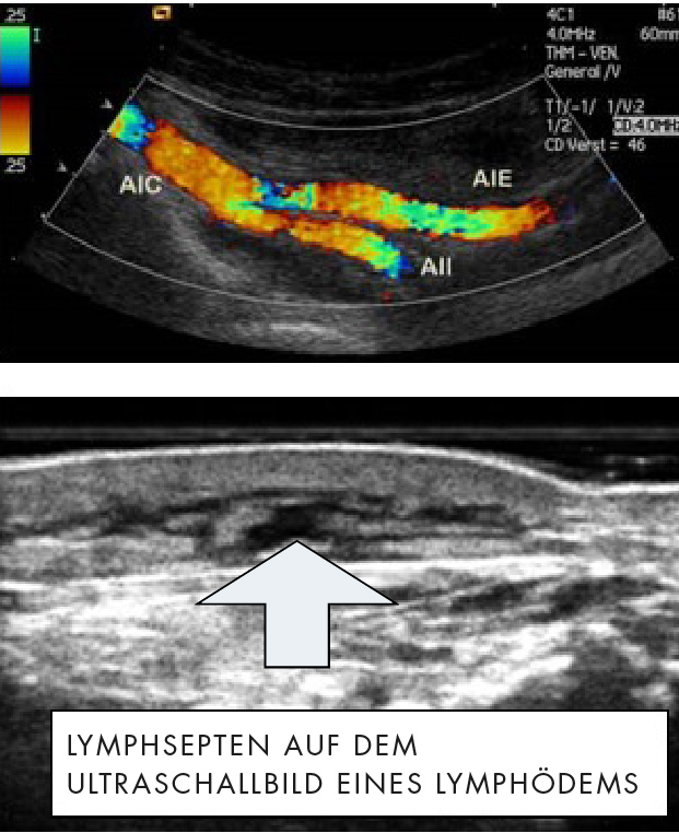 Lipödem Ultraschall