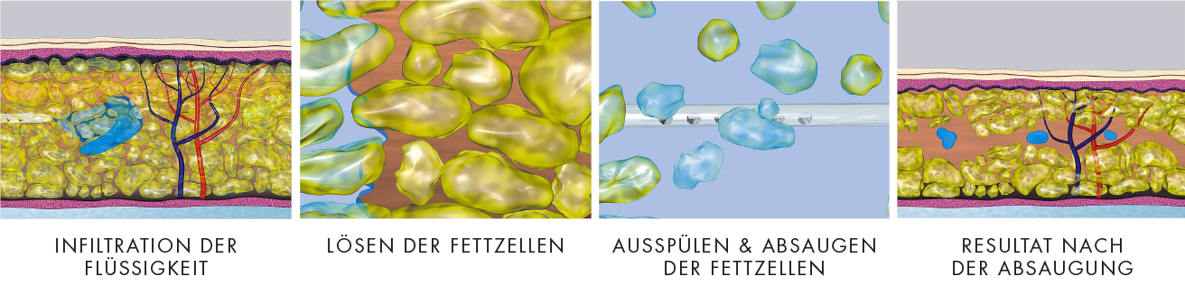 Wasserstrahlabsaugung WAL Lipödem