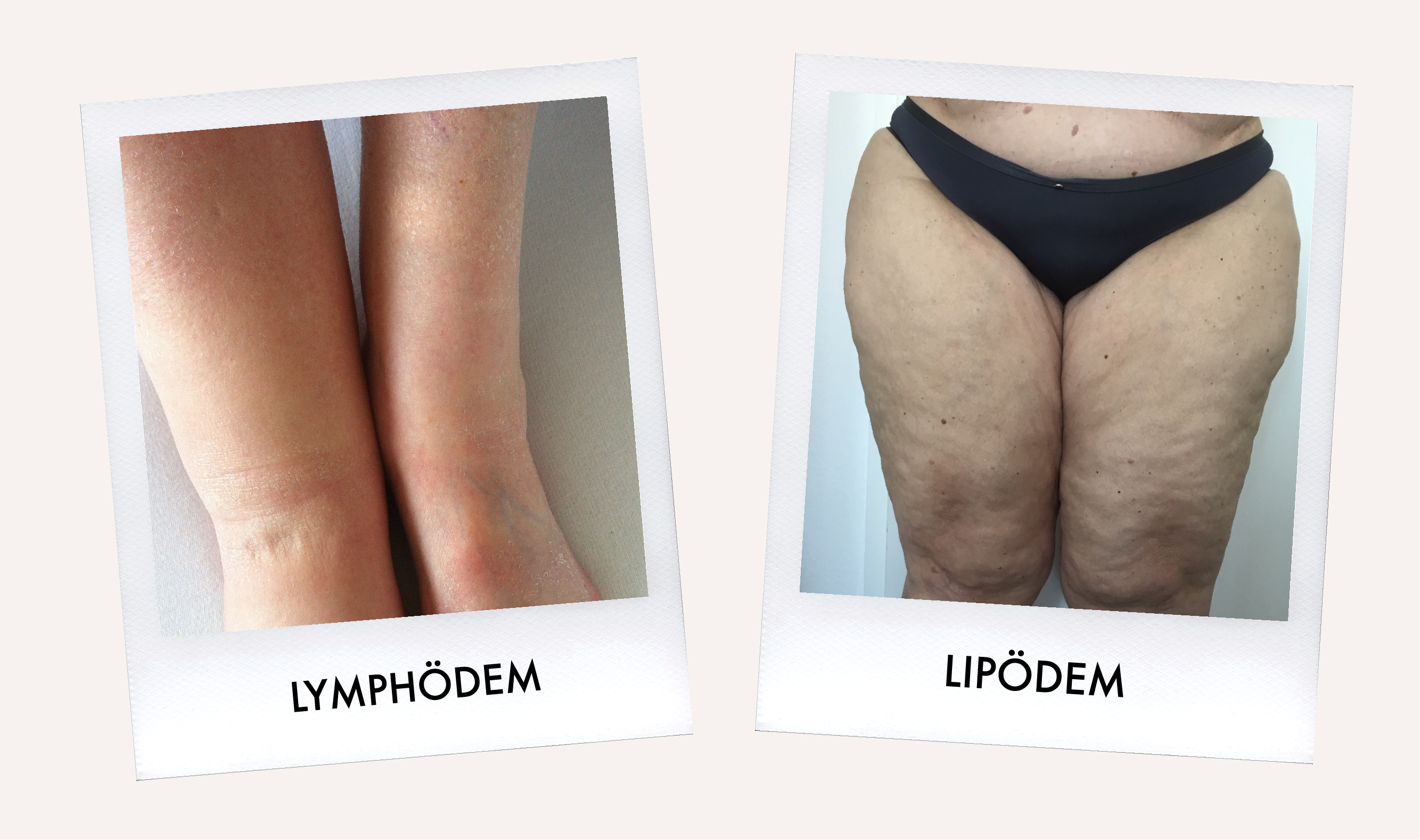 Lipödem oder Lymphödem: Unterschied