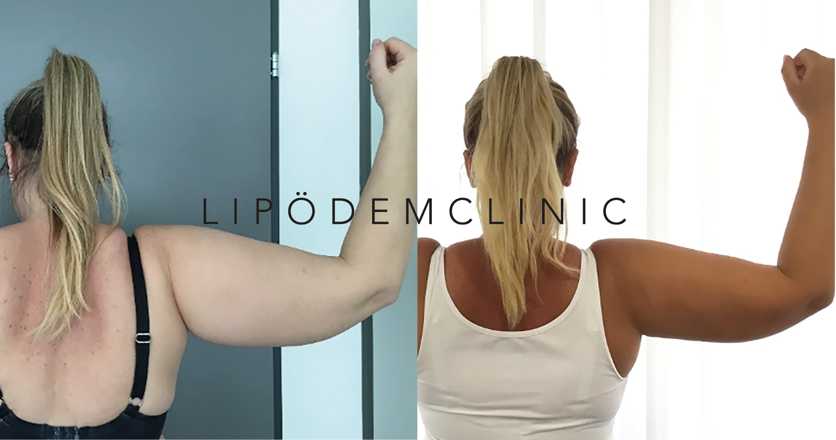 Lipödem Vorher / Nachher LIPÖDEMCLINIC
