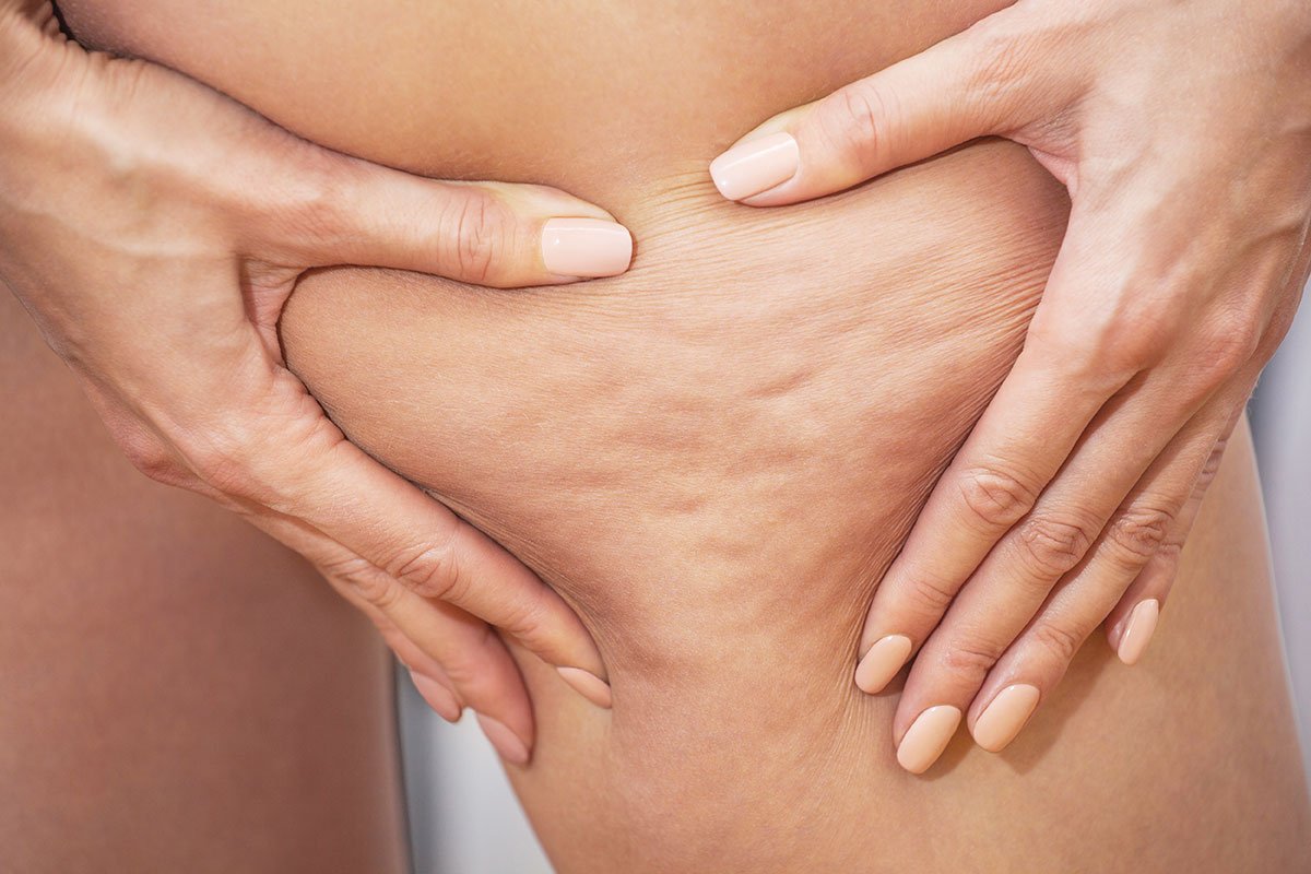 Lipödem Kneiftest: Erkennen Sie die Symptome richtig
