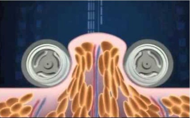 Endermologie als Lipödem Behandlung