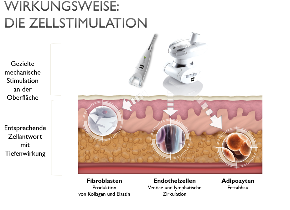 Zellstimulation Lipödem