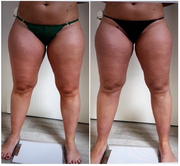 Lymphdrainage Lipödem