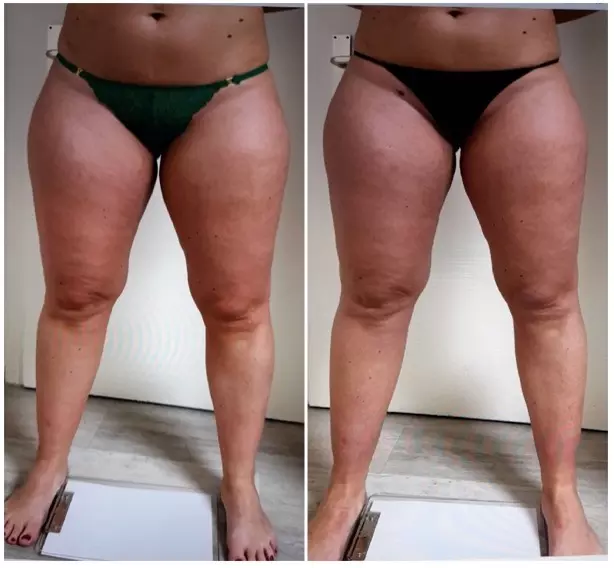 Lymphdrainage Lipödem