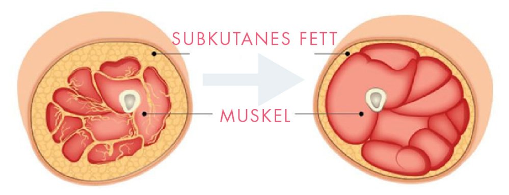 Subkutanes Fett Beine