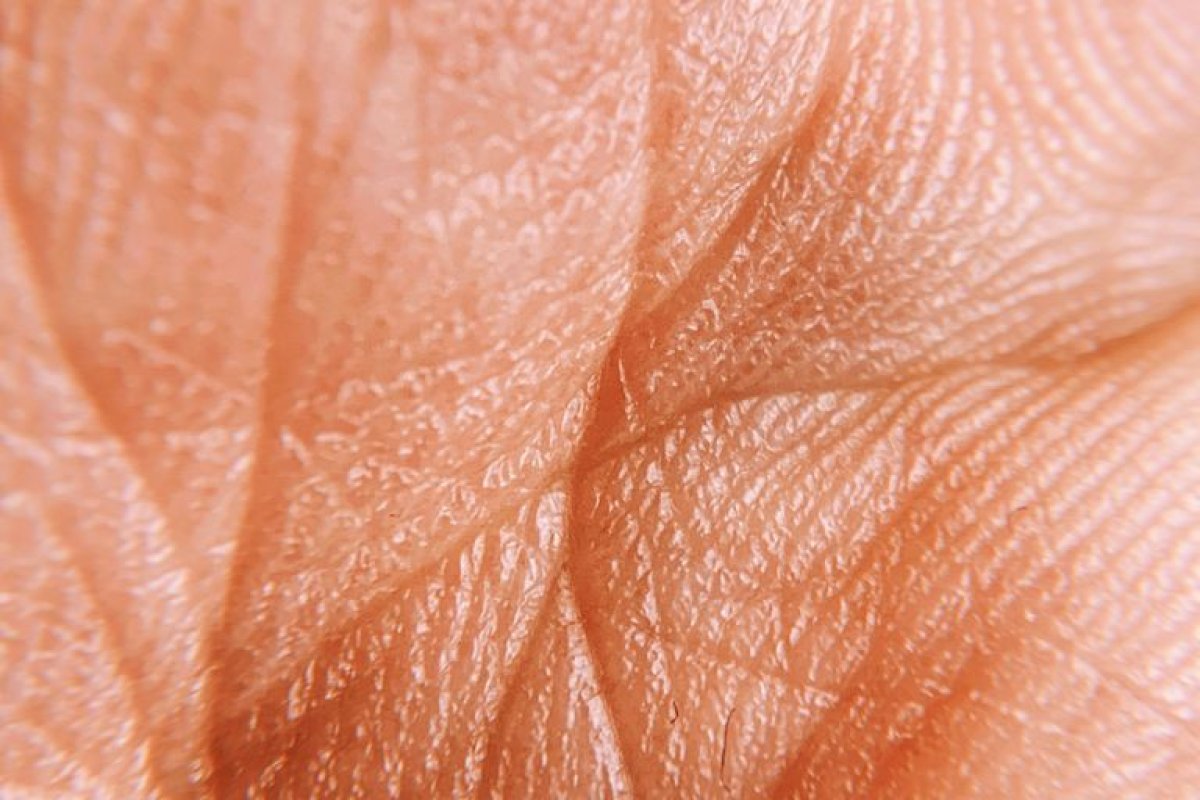 Der Lipödem Kneiftest: Wie erkennt man Lipödem effektiv?