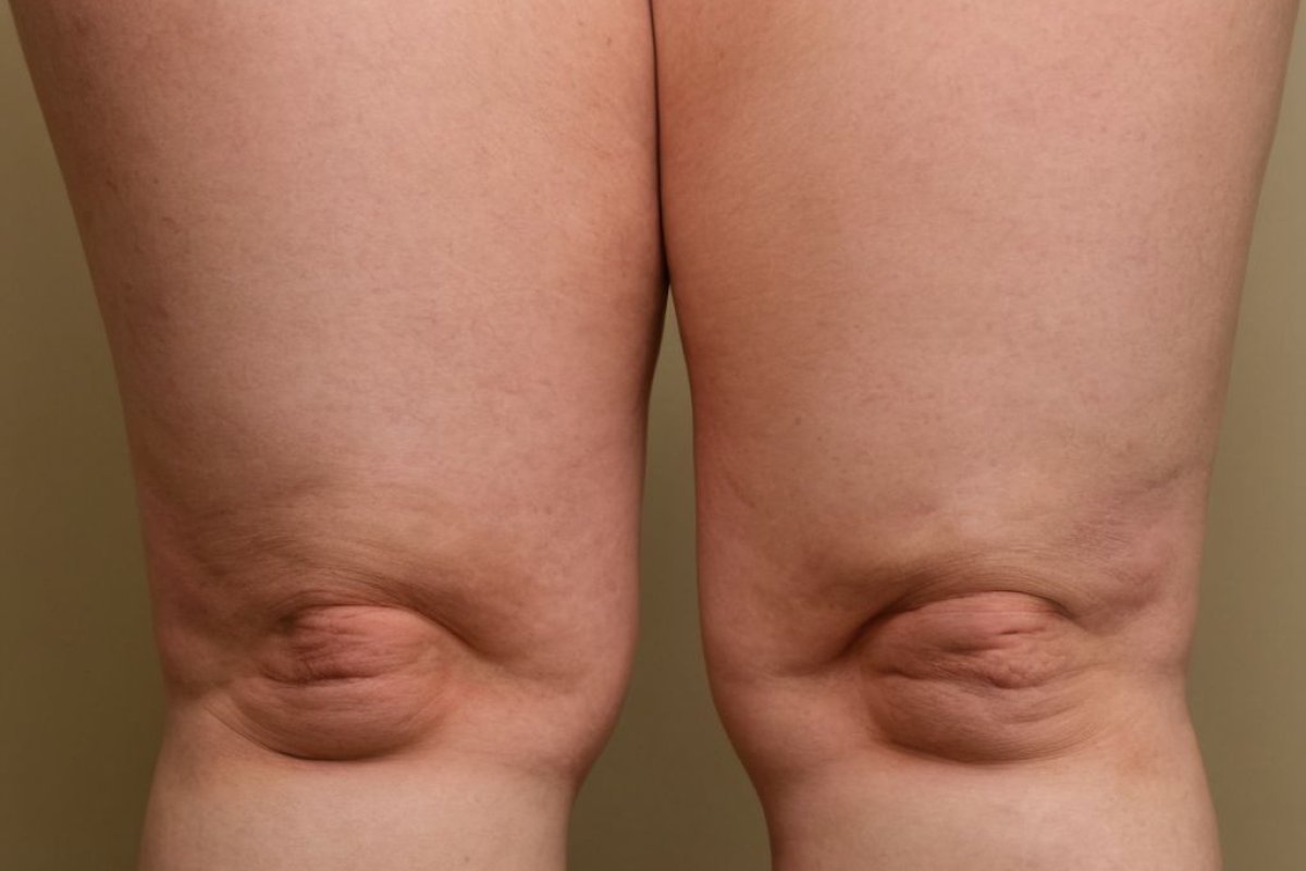 Kalte Beine Lipödem: Symptome und Behandlungsmöglichkeiten