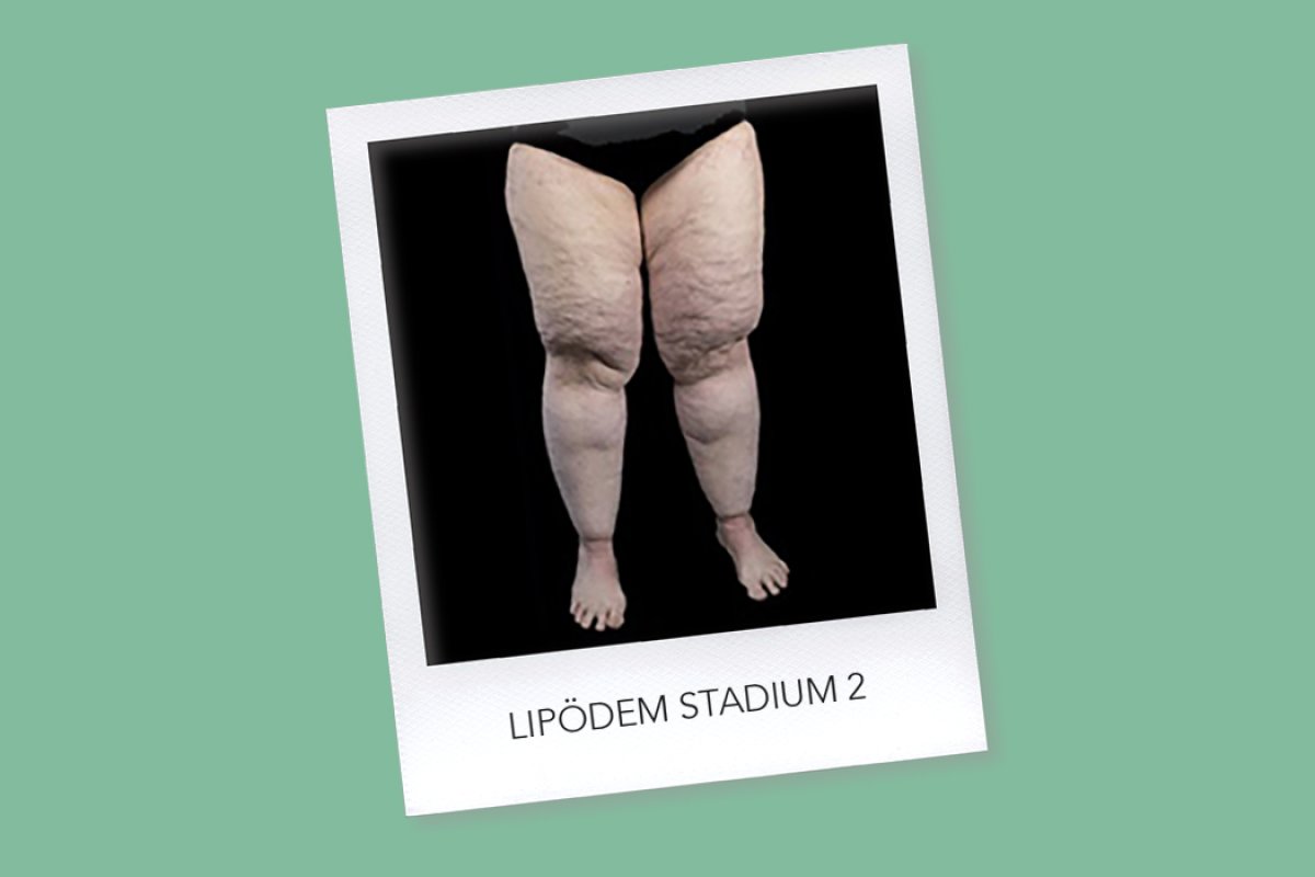 Lipödem Stadium 2: Symptome und Empfehlungen
