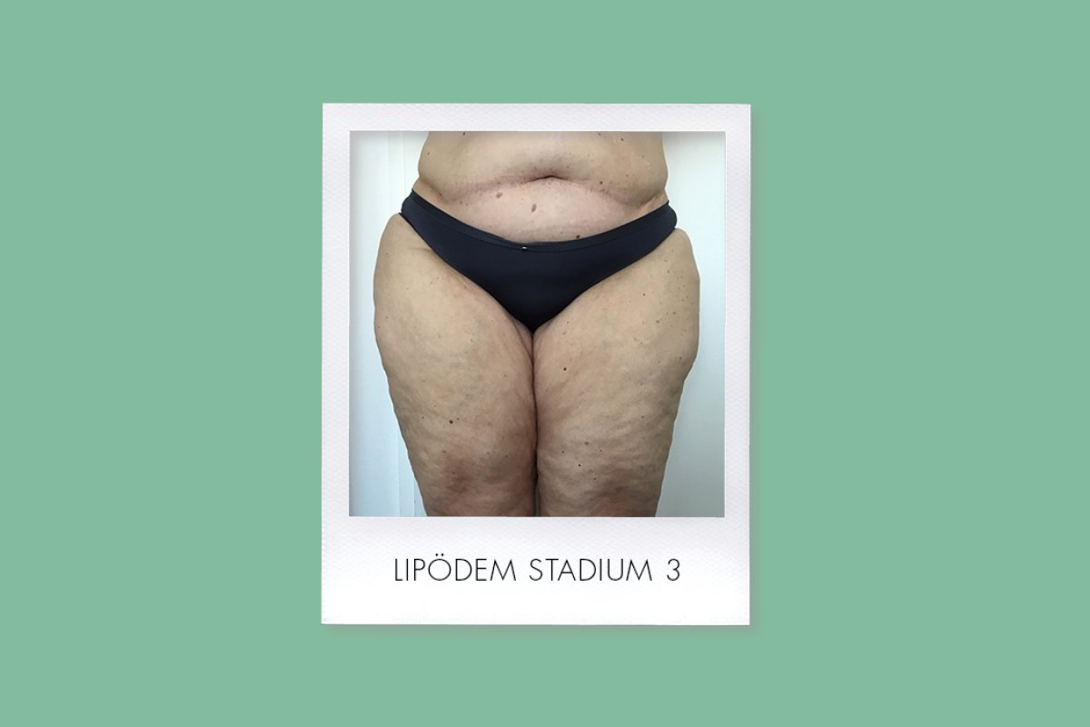Lipödem Stadium 3: Symptome und Empfehlungen