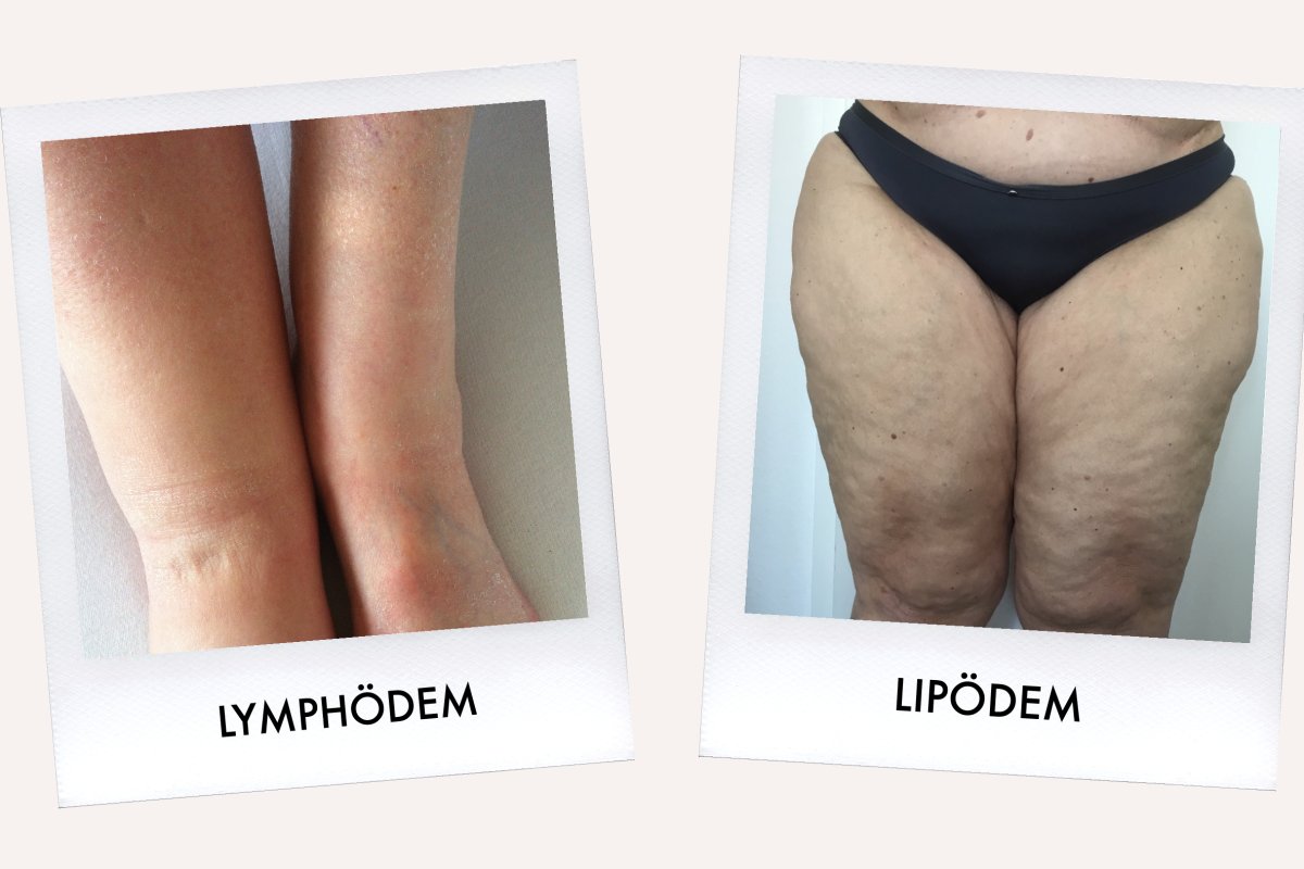 Lipödem oder Lymphödem: Was ist der Unterschied?
