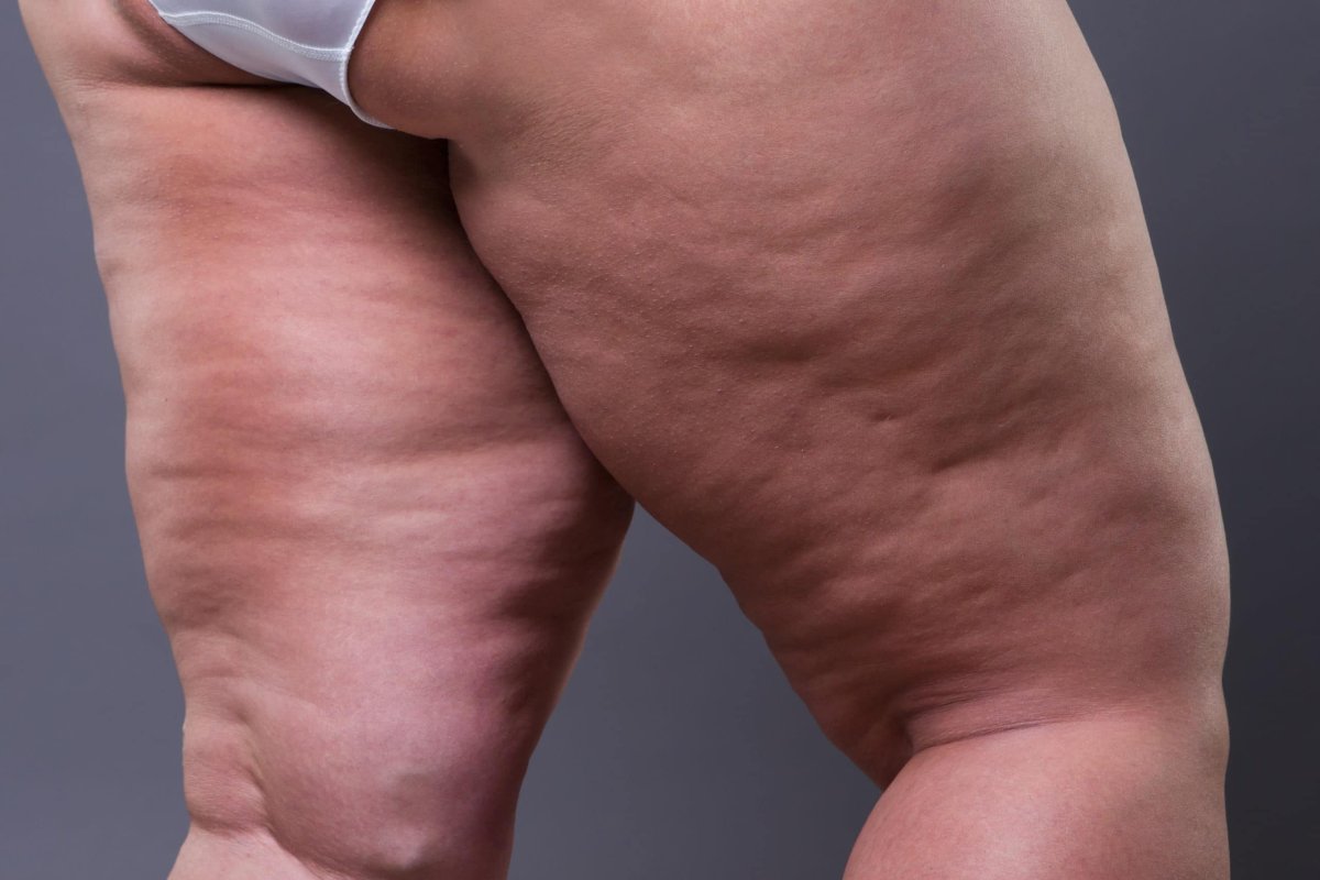 Alles über Lipödem Klinik: Behandlung und Symptome